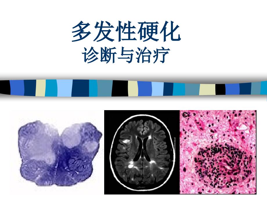 多发性硬化最新疗法探索，希望之光